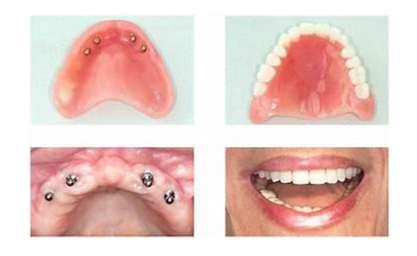 dental implants